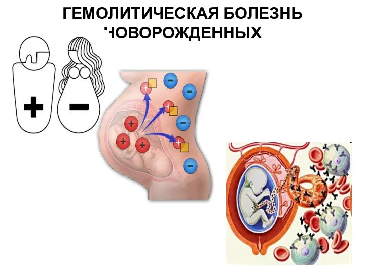 ГЕМОЛИТИЧЕСКАЯ БОЛЕЗНЬ НОВОРОЖДЕННЫХ