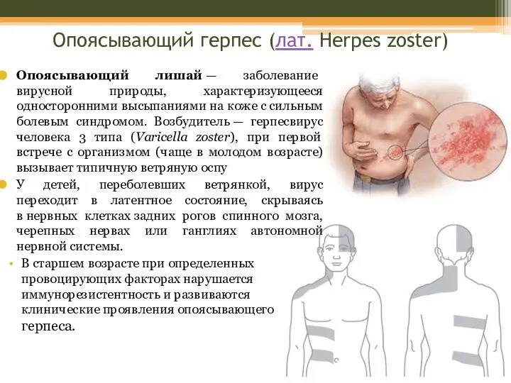 Опоясывающий герпес (лат. Herpes zoster) Опоясывающий лишай — заболевание вирусной природы,