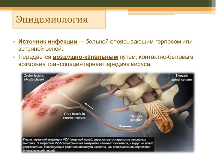 Эпидемиология Источник инфекции — больной опоясывающим герпесом или ветряной оспой. Передается