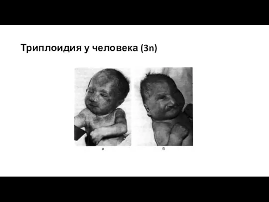 Триплоидия у человека (3n)