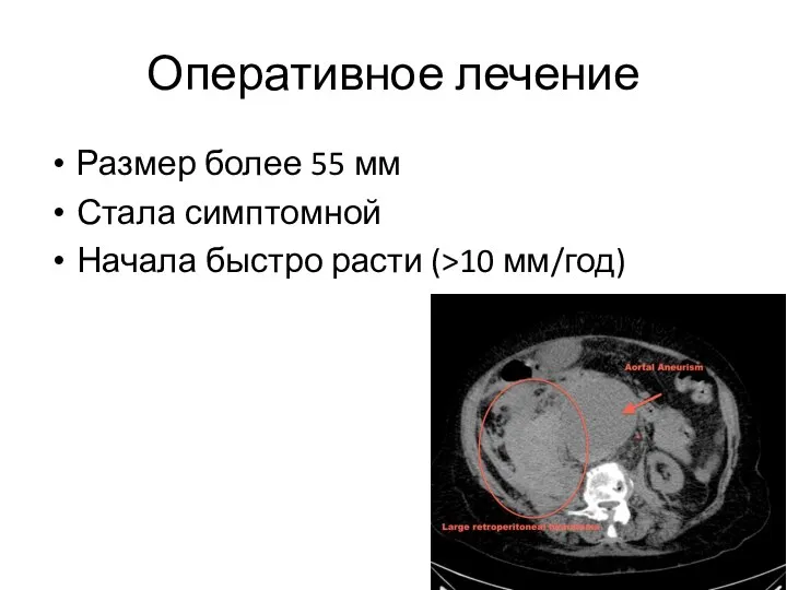 Оперативное лечение Размер более 55 мм Стала симптомной Начала быстро расти (>10 мм/год)