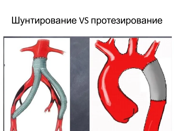 Шунтирование VS протезирование