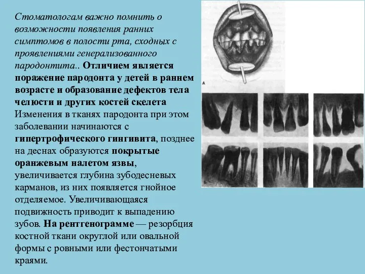 Стоматологам важно помнить о возможности появления ранних симптомов в полости рта,