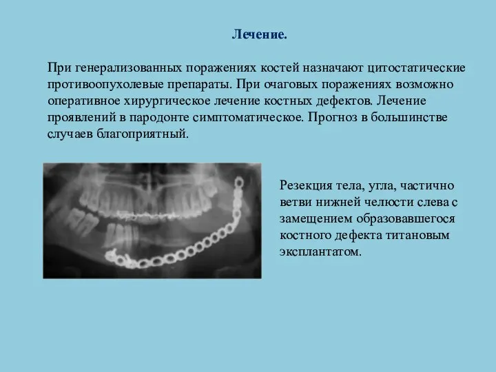 Лечение. При генерализованных поражениях костей назначают цитостатические противоопухолевые препараты. При очаговых