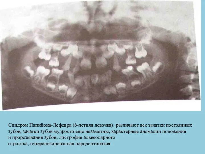 Синдром Папийона-Лефевра (6-летняя девочка): различают все зачатки постоянных зубов, зачатки зубов
