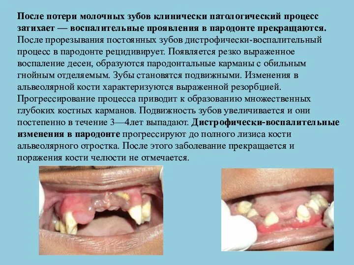 После потери молочных зубов клинически патологический процесс затихает — воспалительные проявления