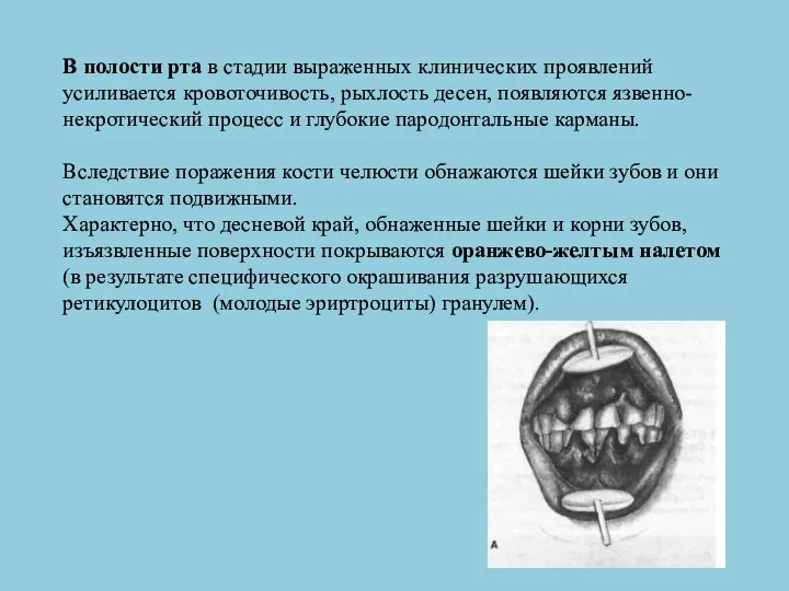 В полости рта в стадии выраженных клинических проявлений усиливается кровоточивость, рыхлость