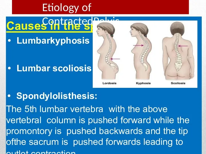 Causes in the spine Lumbarkyphosis Lumbar scoliosis Spondylolisthesis: The 5th lumbar