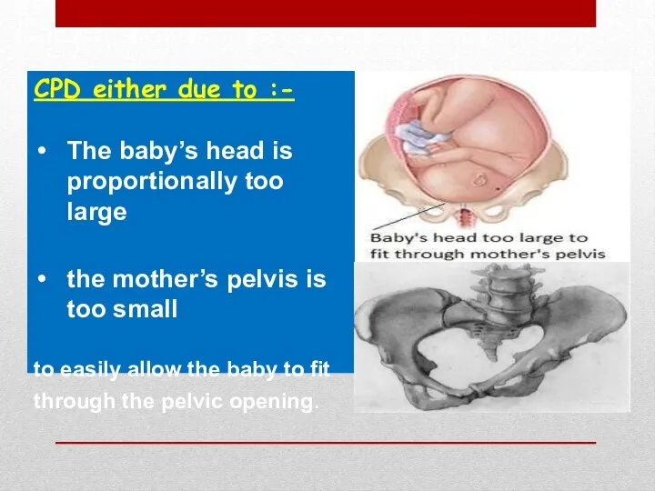 CPD either due to :- The baby’s head is proportionally too