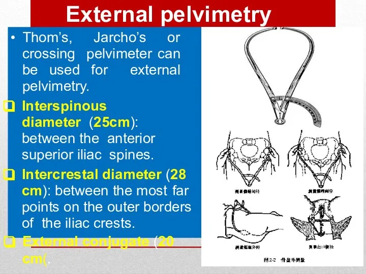 External pelvimetry Thom’s, Jarcho’s or crossing pelvimeter can be used for