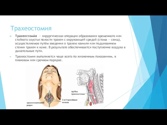 Трахеостомия Трахеостоми́я — хирургическая операция образования временного или стойкого соустья полости