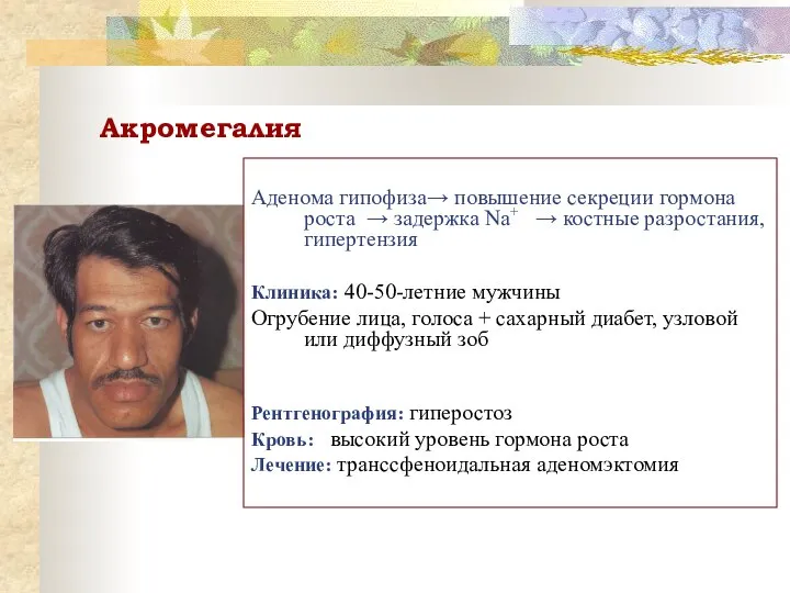 Акромегалия Аденома гипофиза→ повышение секреции гормона роста → задержка Na+ →