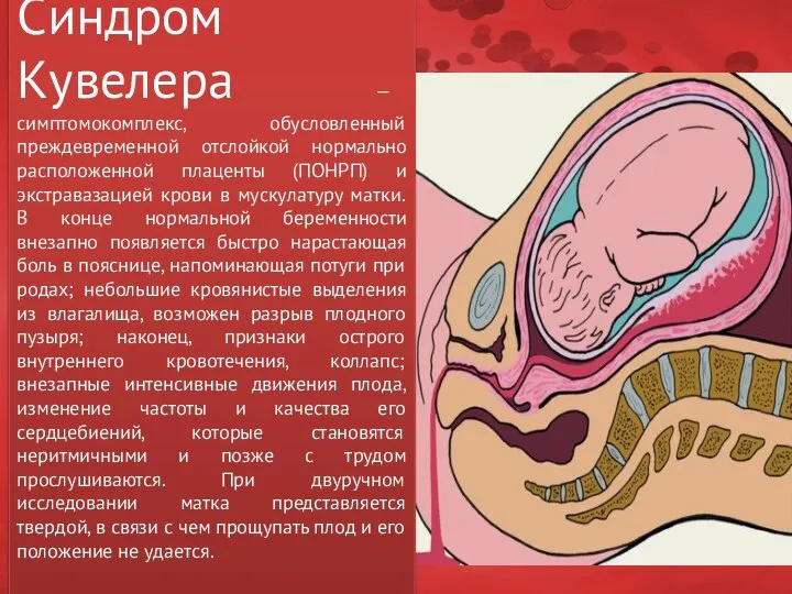 Синдром Кувелера — симптомокомплекс, обусловленный преждевременной отслойкой нормально расположенной плаценты (ПОНРП)