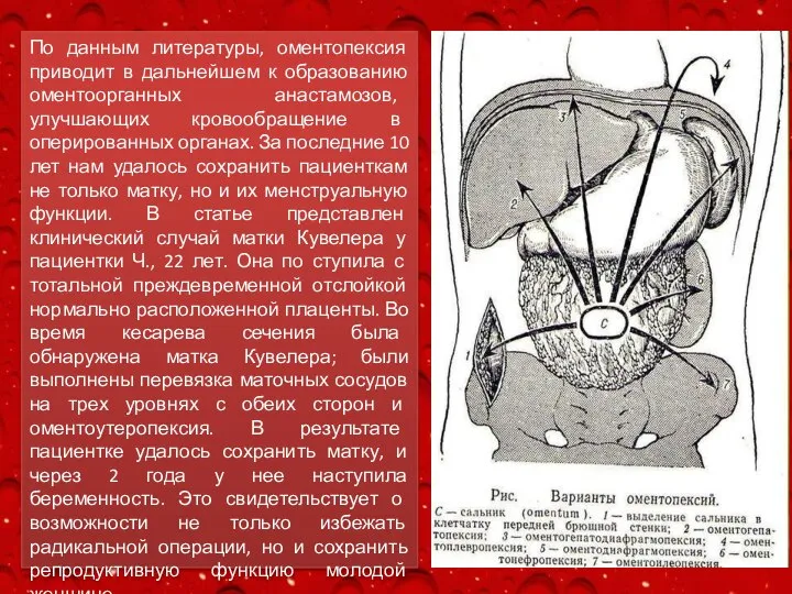 По данным литературы, оментопексия приводит в дальнейшем к образованию оментоорганных анастамозов,