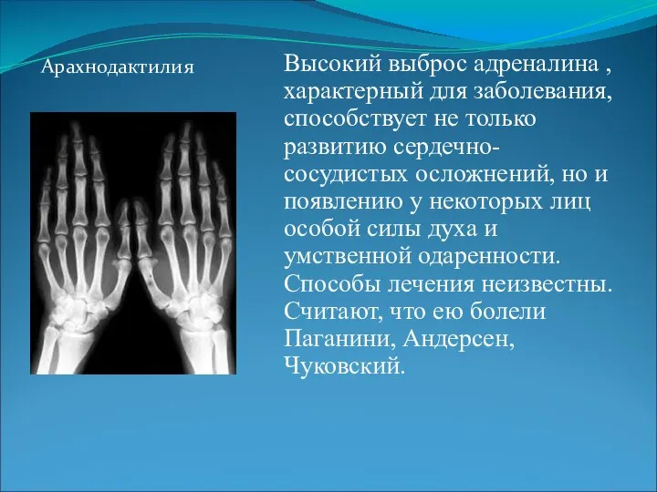 Арахнодактилия Высокий выброс адреналина , характерный для заболевания, способствует не только