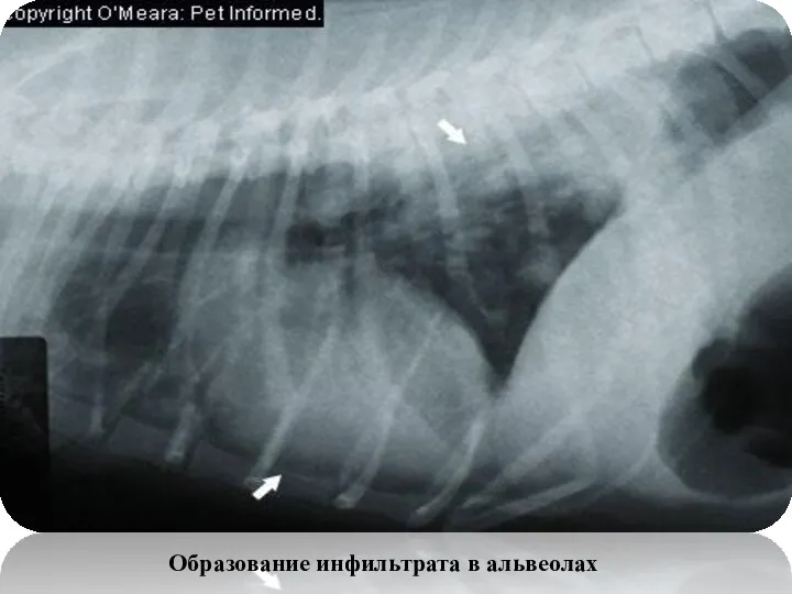 Образование инфильтрата в альвеолах
