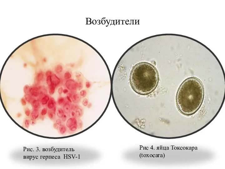 Возбудители Рис. 3. возбудитель вирус герпеса HSV-1 Рис 4. яйца Токсокара (toxocara)