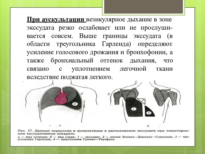 При аускультации везикулярное дыхание в зоне экссудата резко ослабевает или не