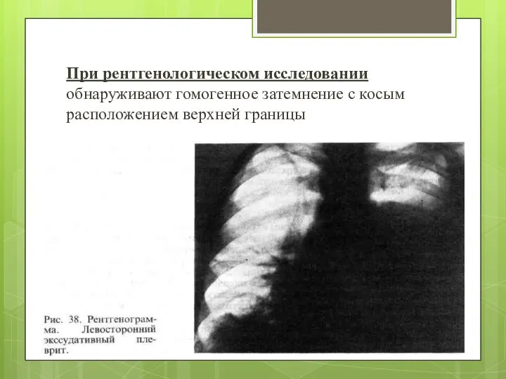 При рентгенологическом исследовании обнаруживают гомогенное затемнение с косым расположением верхней границы