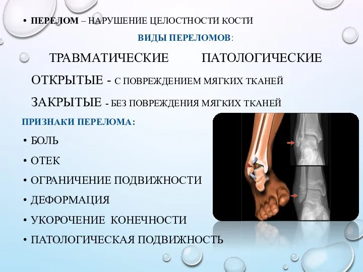 ПЕРЕЛОМ – НАРУШЕНИЕ ЦЕЛОСТНОСТИ КОСТИ ВИДЫ ПЕРЕЛОМОВ: ТРАВМАТИЧЕСКИЕ ПАТОЛОГИЧЕСКИЕ ОТКРЫТЫЕ -