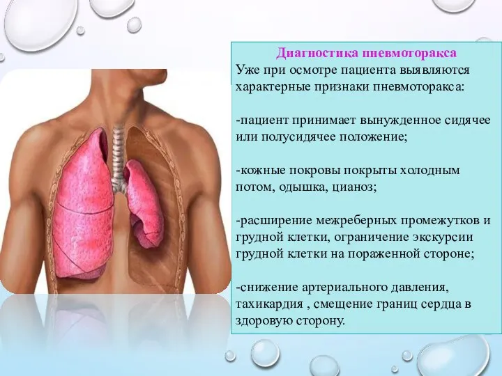 Диагностика пневмоторакса Уже при осмотре пациента выявляются характерные признаки пневмоторакса: -пациент