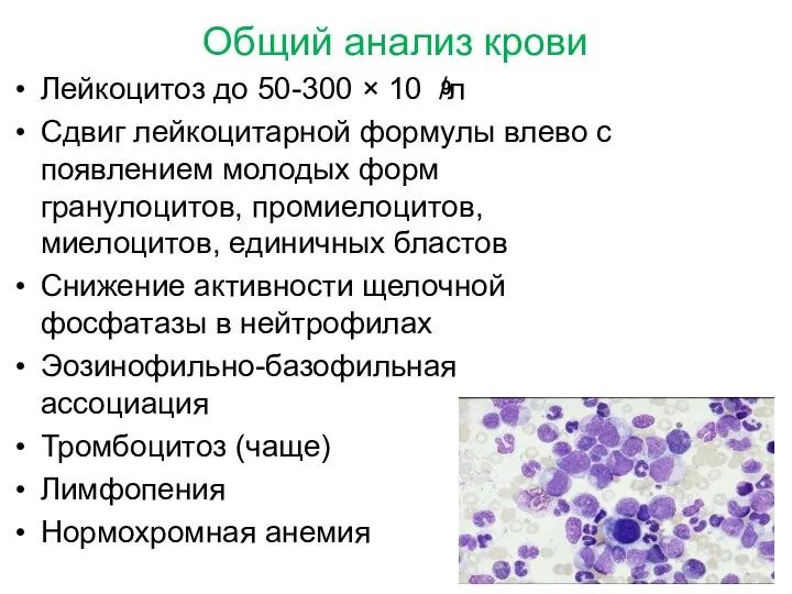 Общий анализ крови Лейкоцитоз до 50-300 × 10 /л Сдвиг лейкоцитарной