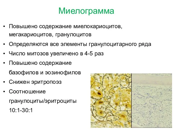 Миелограмма Повышено содержание миелокариоцитов, мегакариоцитов, гранулоцитов Определяются все элементы гранулоцитарного ряда