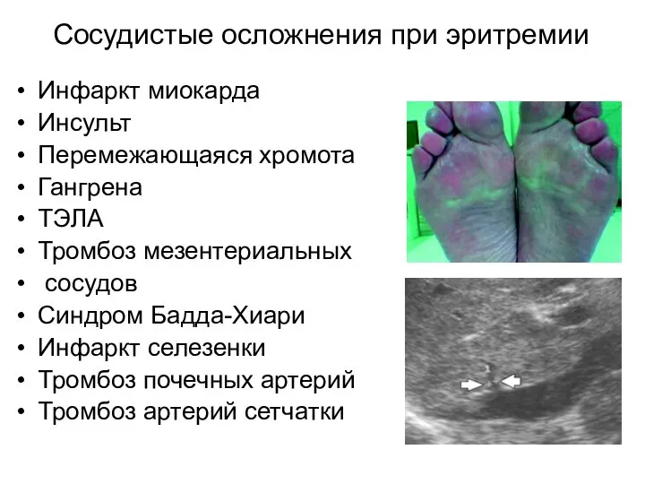 Сосудистые осложнения при эритремии Инфаркт миокарда Инсульт Перемежающаяся хромота Гангрена ТЭЛА