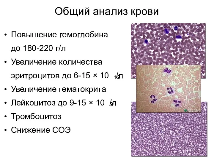 Общий анализ крови Повышение гемоглобина до 180-220 г/л Увеличение количества эритроцитов