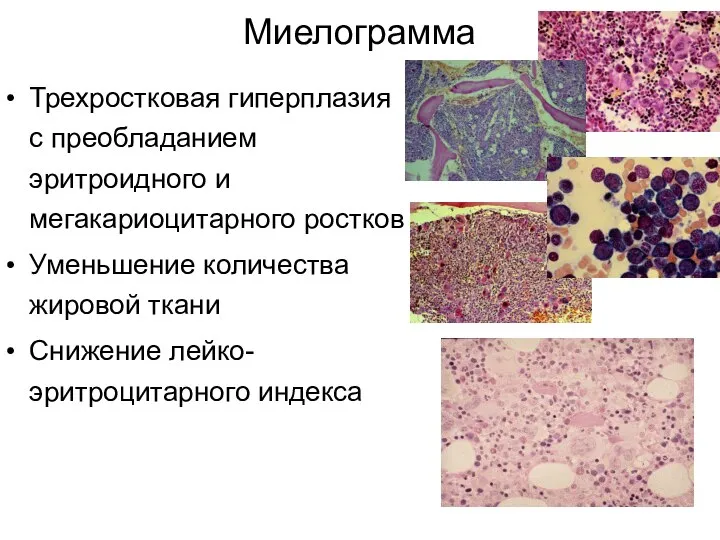 Миелограмма Трехростковая гиперплазия с преобладанием эритроидного и мегакариоцитарного ростков Уменьшение количества жировой ткани Снижение лейко-эритроцитарного индекса