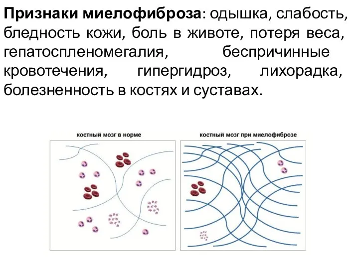 Признаки миелофиброза: одышка, слабость, бледность кожи, боль в животе, потеря веса,