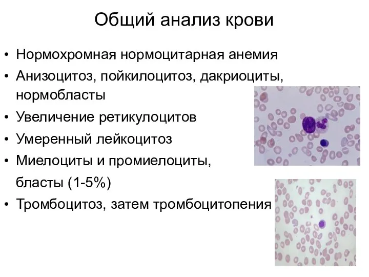 Общий анализ крови Нормохромная нормоцитарная анемия Анизоцитоз, пойкилоцитоз, дакриоциты, нормобласты Увеличение