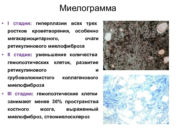 Миелограмма I стадия: гиперплазия всех трех ростков кроветворения, особенно мегакариоцитарного, очаги