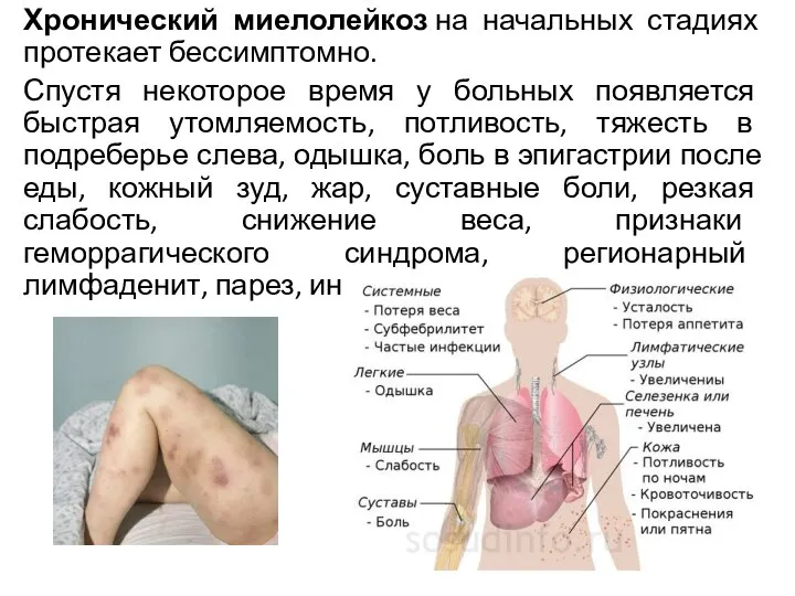 Хронический миелолейкоз на начальных стадиях протекает бессимптомно. Спустя некоторое время у