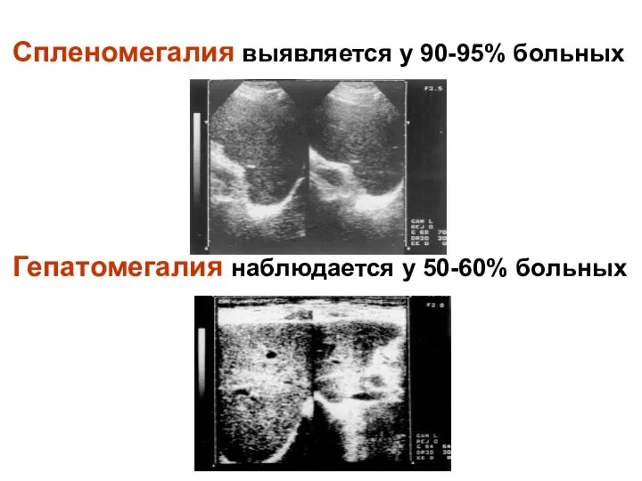 Спленомегалия выявляется у 90-95% больных Гепатомегалия наблюдается у 50-60% больных