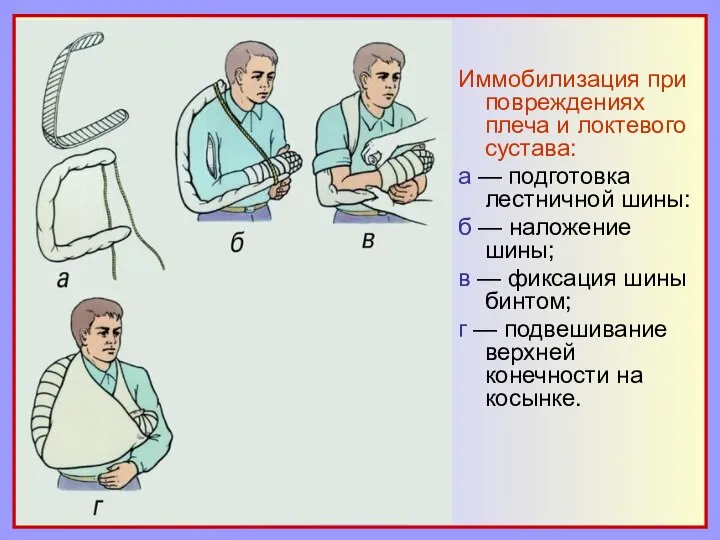 Иммобилизация при повреждениях плеча и локтевого сустава: а — подготовка лестничной