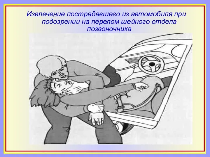 Извлечение пострадавшего из автомобиля при подозрении на перелом шейного отдела позвоночника