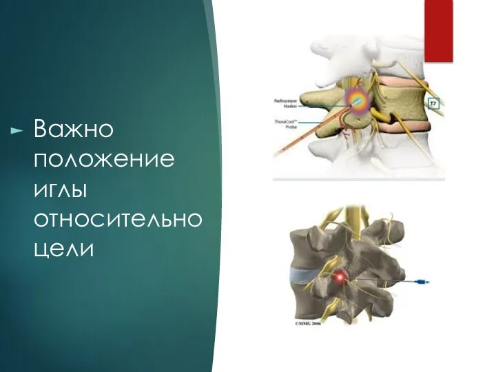 Важно положение иглы относительно цели