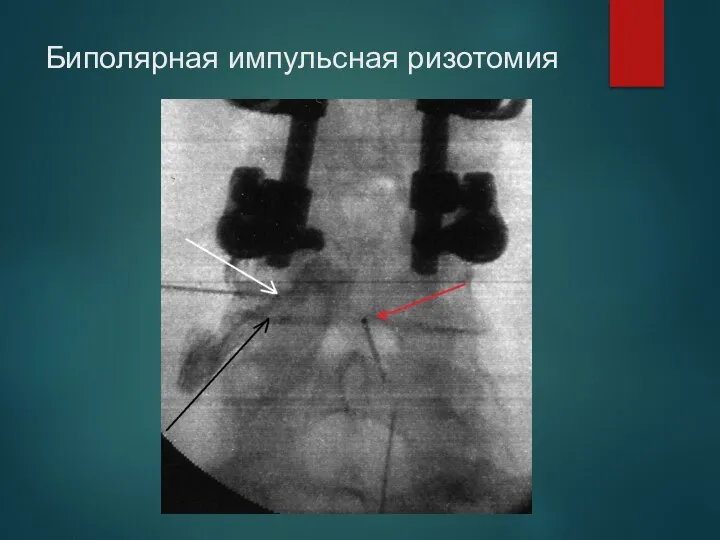 Биполярная импульсная ризотомия