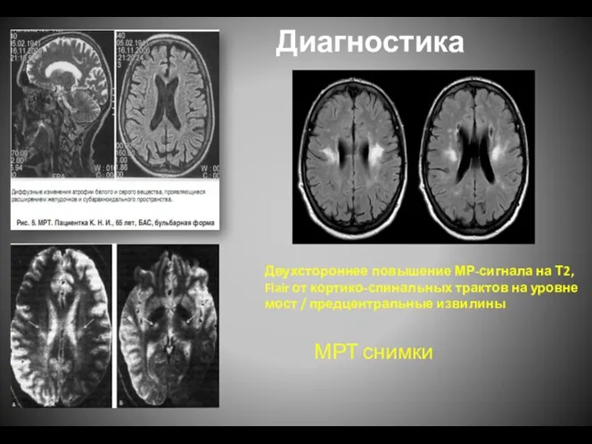 Диагностика МРТ снимки Двухстороннее повышение МР-сигнала на Т2, Flair от кортико-спинальных