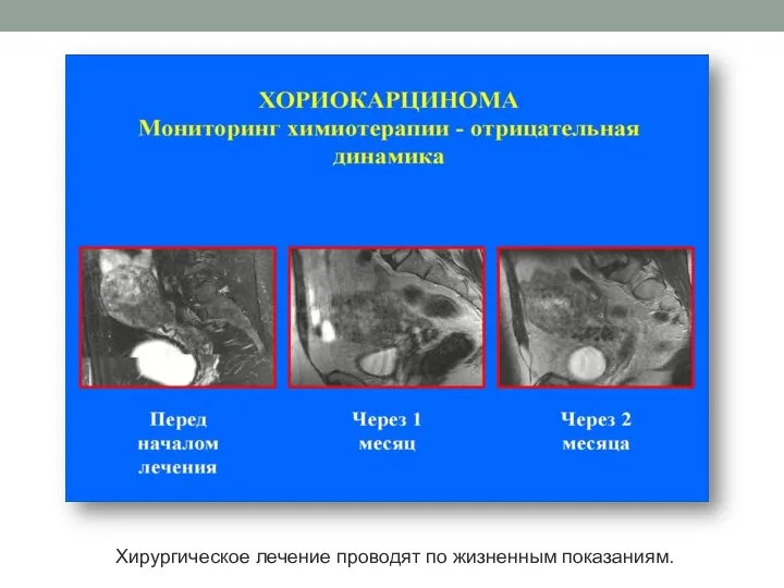 Хирургическое лечение проводят по жизненным показаниям.