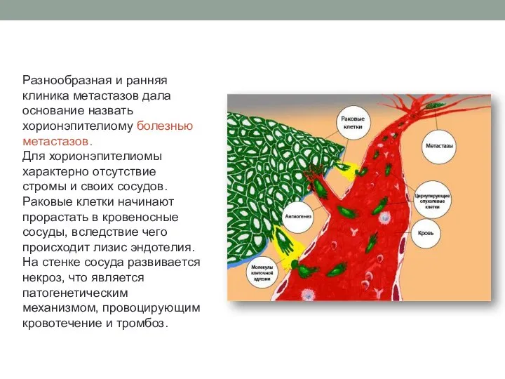 Разнообразная и ранняя клиника метастазов дала основание назвать хорионэпителиому болезнью метастазов.