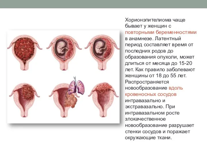 Хорионэпителиома чаще бывает у женщин с повторными беременностями в анамнезе. Латентный