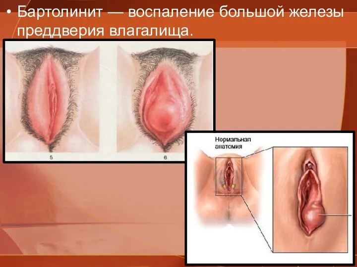 Бартолинит — воспаление большой железы преддверия влагалища.