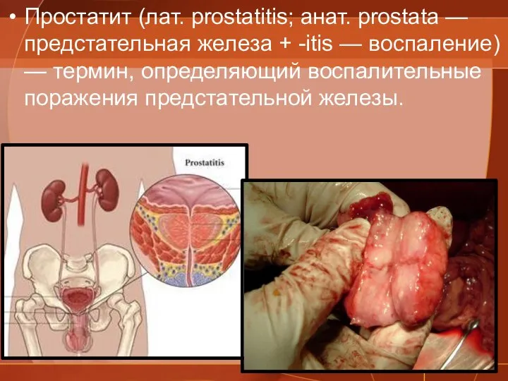 Простатит (лат. prostatitis; анат. prostata — предстательная железа + -itis —