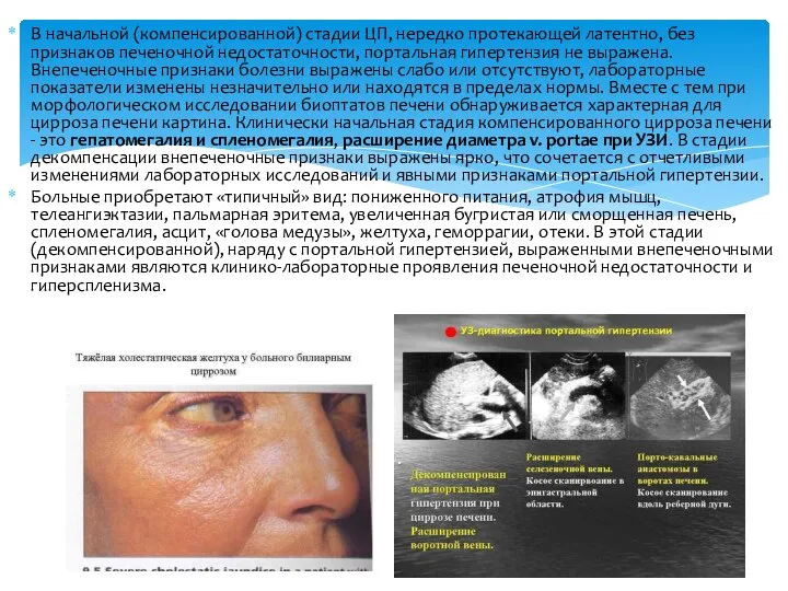 В начальной (компенсированной) стадии ЦП, нередко протекающей латентно, без признаков печеночной