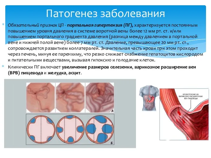 Обязательный признак ЦП - портальная гипертензия (ПГ), характеризуется постоянным повышением уровня