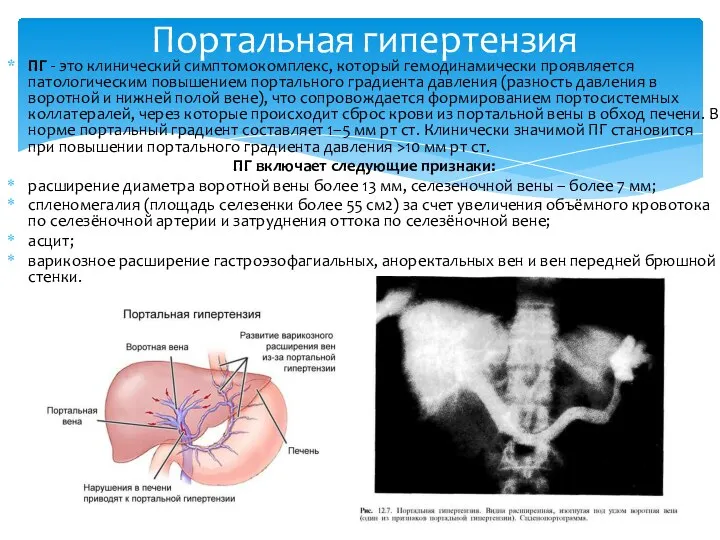 ПГ - это клинический симптомокомплекс, который гемодинамически проявляется патологическим повышением портального