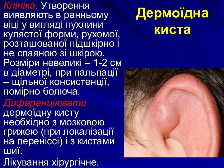 Дермоїдна киста Клініка. Утворення виявляють в ранньому віці у вигляді пухлини