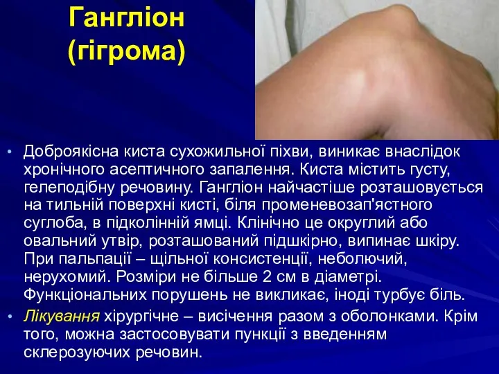 Гангліон (гігрома) Доброякісна киста сухожильної піхви, виникає внаслідок хронічного асептичного запалення.